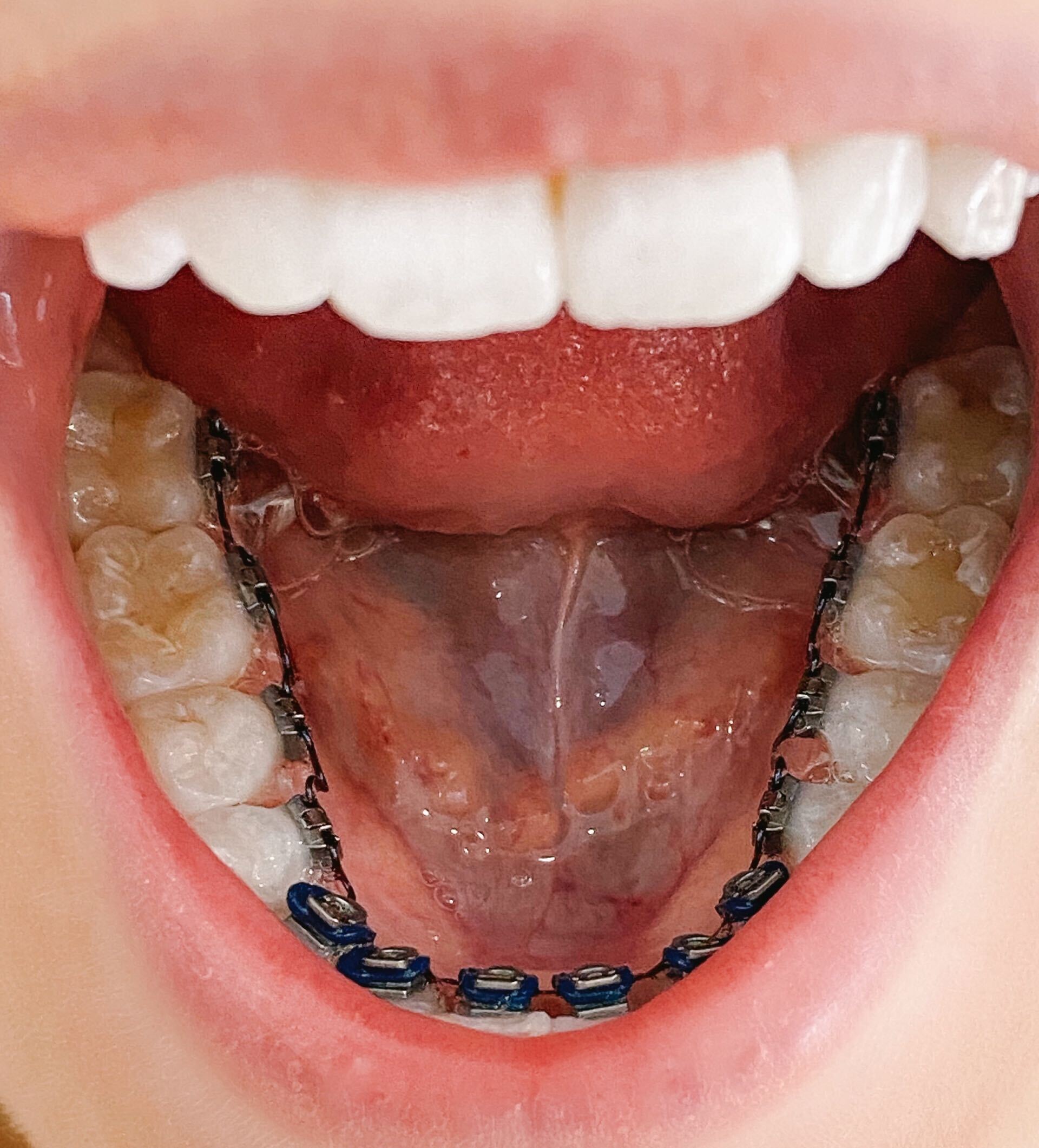 Common Concerns Surrounding Adult Braces