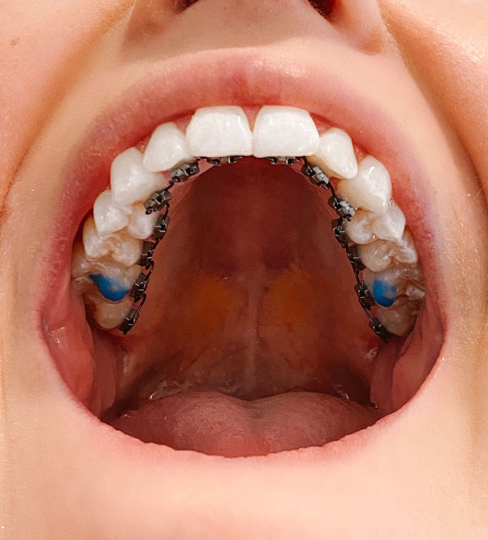 The Ultimate Guide to Adult Braces - Sturgill Orthodontics