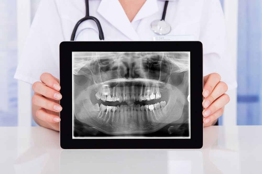 Dental X-Ray Myths