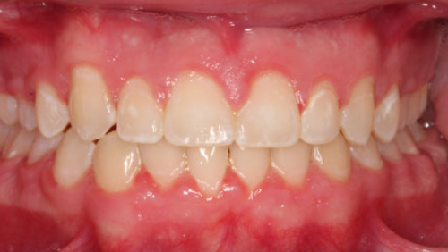 CD-After
