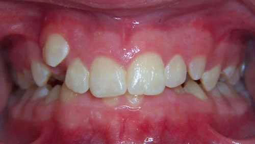 CD-Before