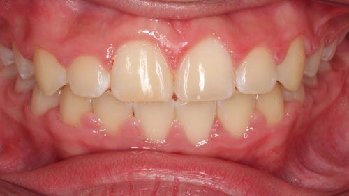 Impacted-teeth-After