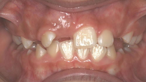 Impacted-teeth-before