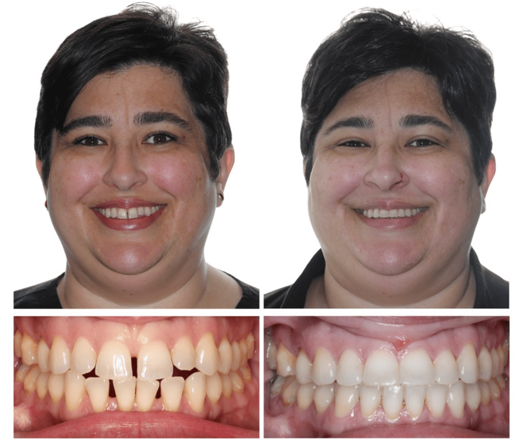 Gap Teeth Treatment in Johnson City