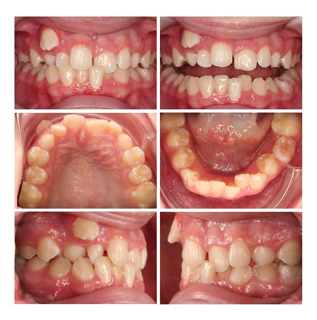 What Does It Mean When Your Teeth Are Crowded?