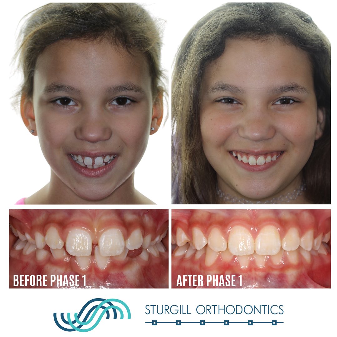 Phase 1 Braces in Johnson City