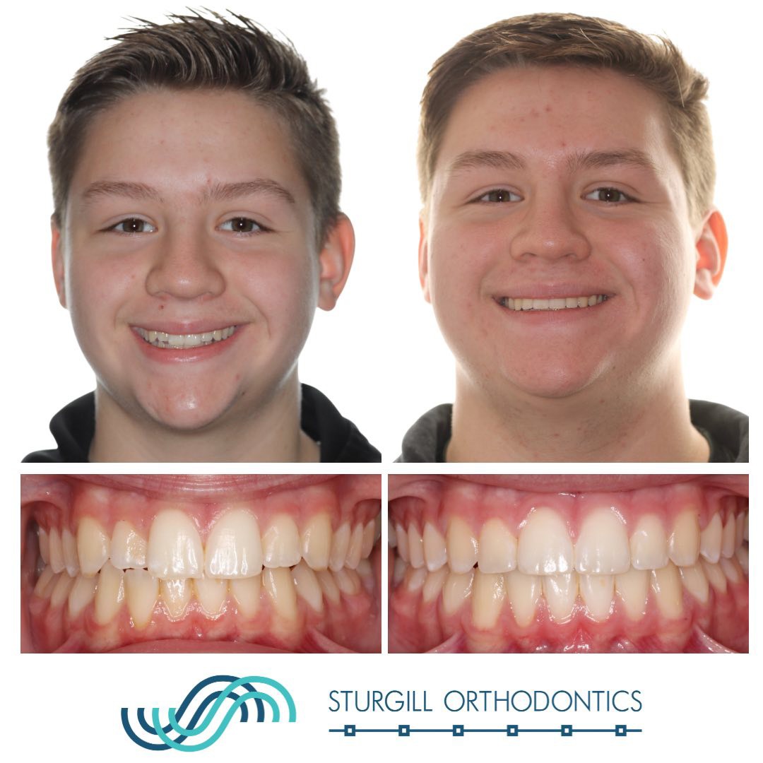 You Can Go Straight to an Orthodontist in Johnson City