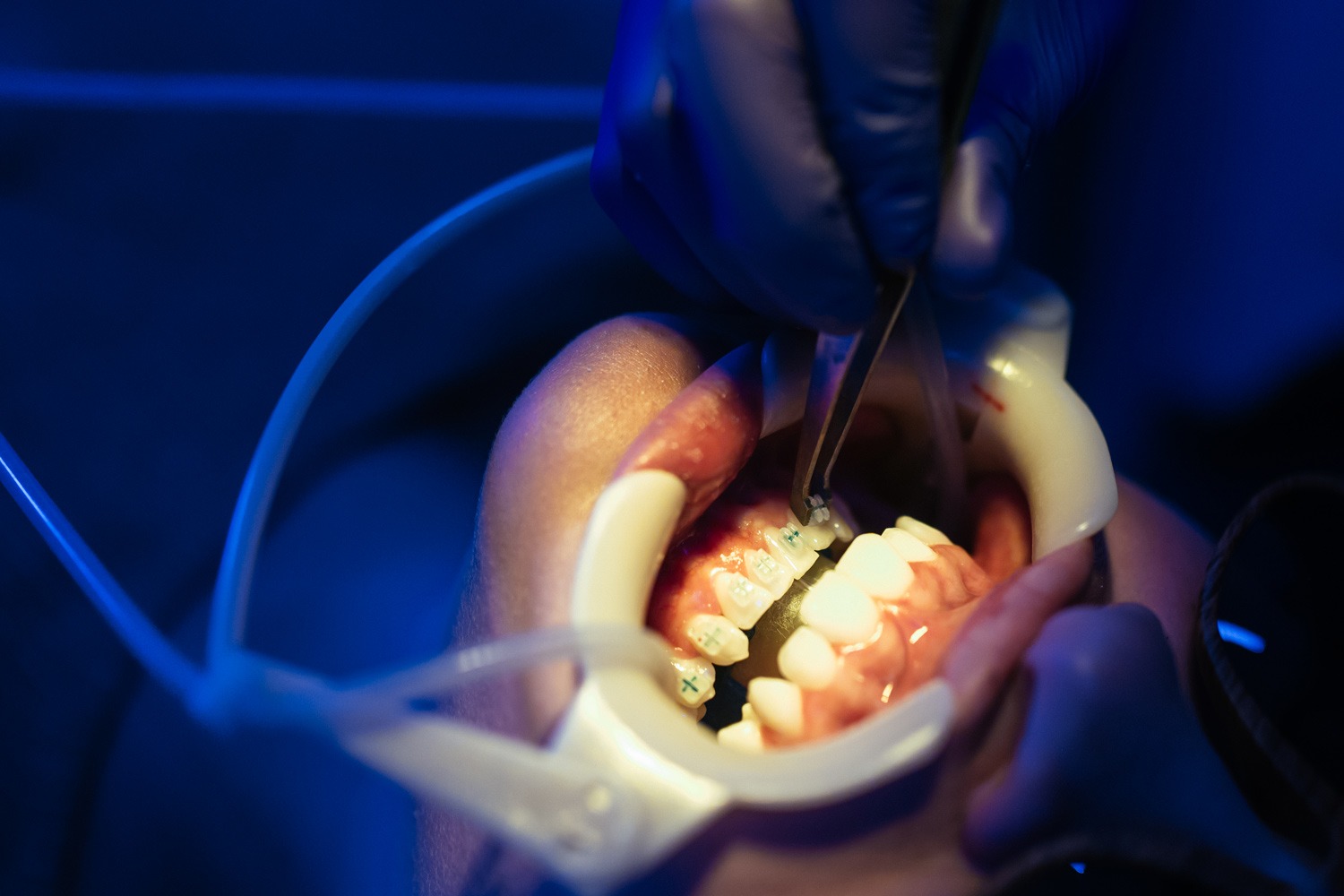 Answers to Common Questions About Same-Day Braces in Johnson City and Bristol