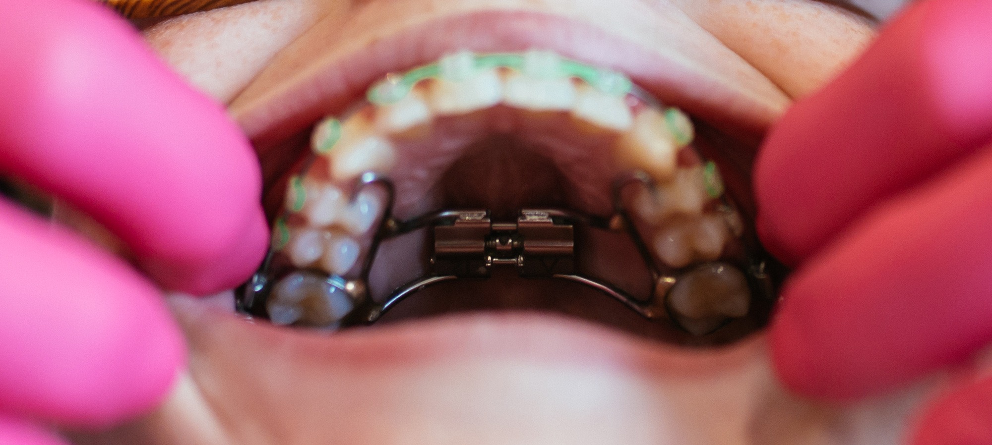 Close-up view of a palatal expander device installed in a patient's mouth, showing the metal framework attached to the upper teeth with the expansion mechanism visible in the center
