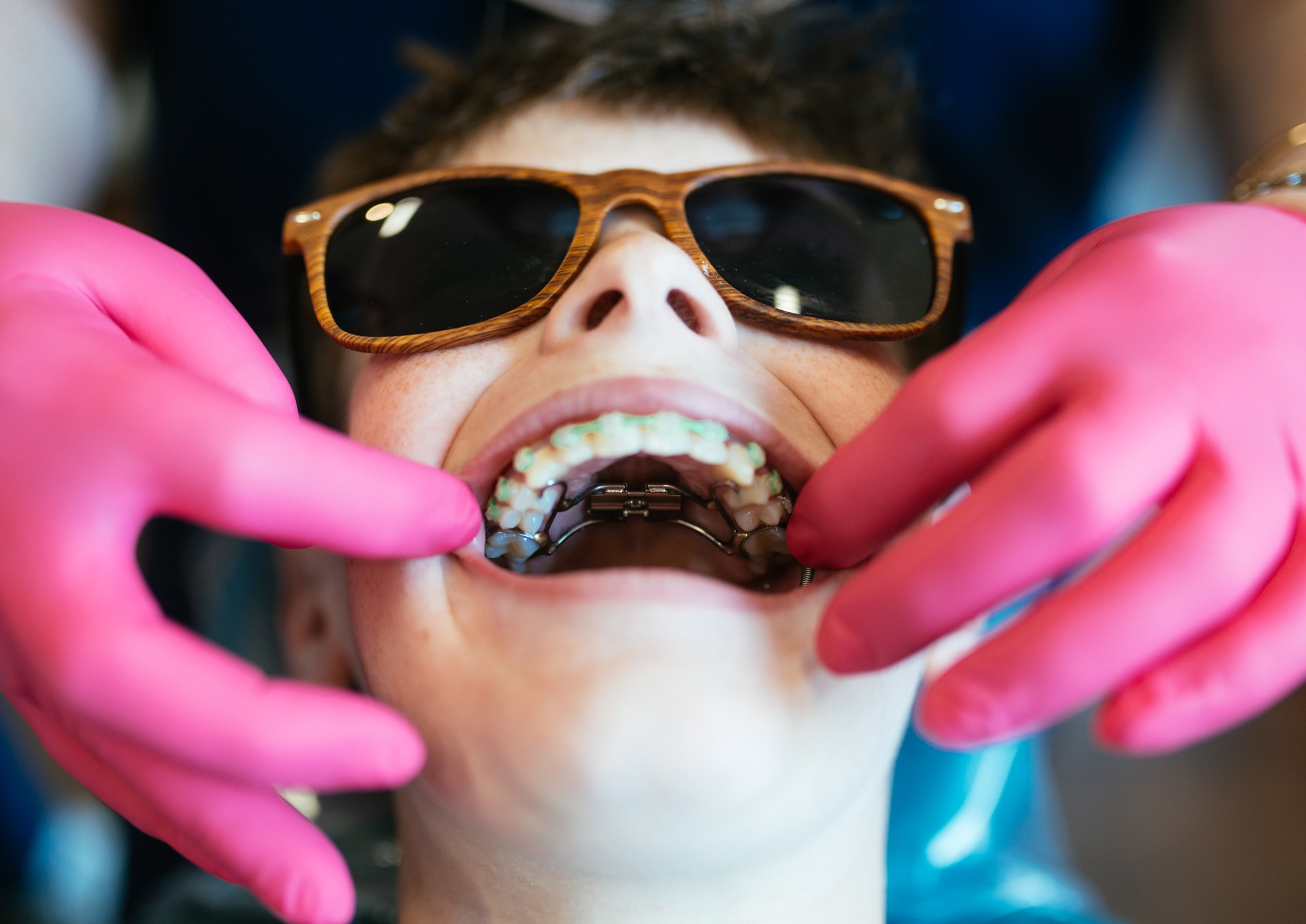Young patient during orthodontic treatment showing palatal expander device in mouth while orthodontist's hands in pink gloves provide care