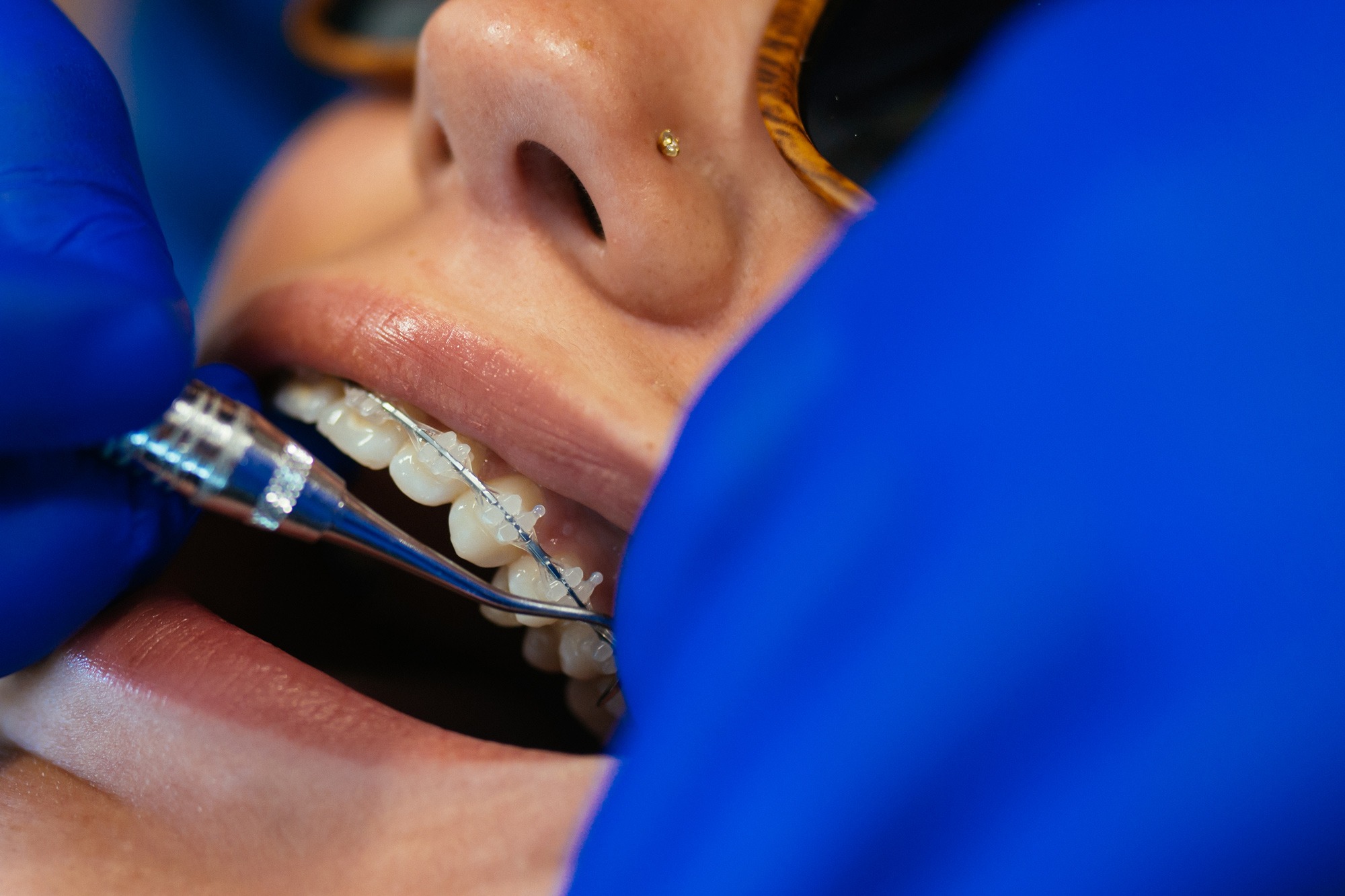 Clear ceramic braces being adjusted during underbite treatment at orthodontic office in Bristol, TN