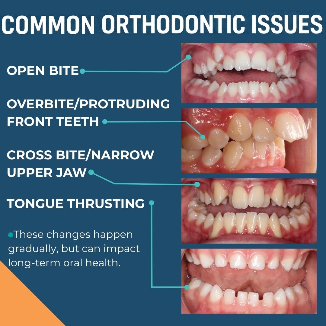 Sturgill Orthodontics infographic showing common orthodontic issues from thumb sucking including open bite, overbite, crossbite, and tongue thrusting treated at our Johnson City, Bristol, and Norton VA offices