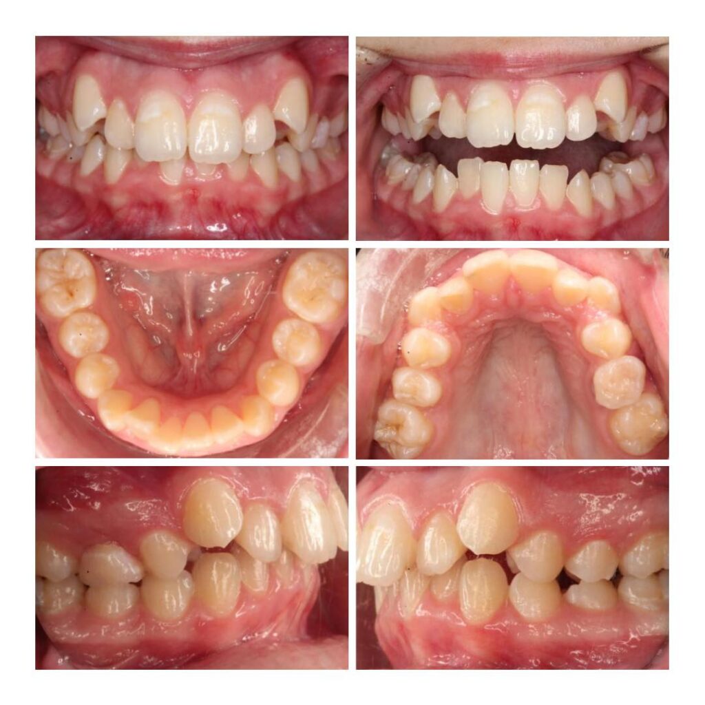 Clinical before photos showing Class II malocclusion, severe crowding, excess overjet, and high canines prior to orthodontic treatment at Sturgill Orthodontics