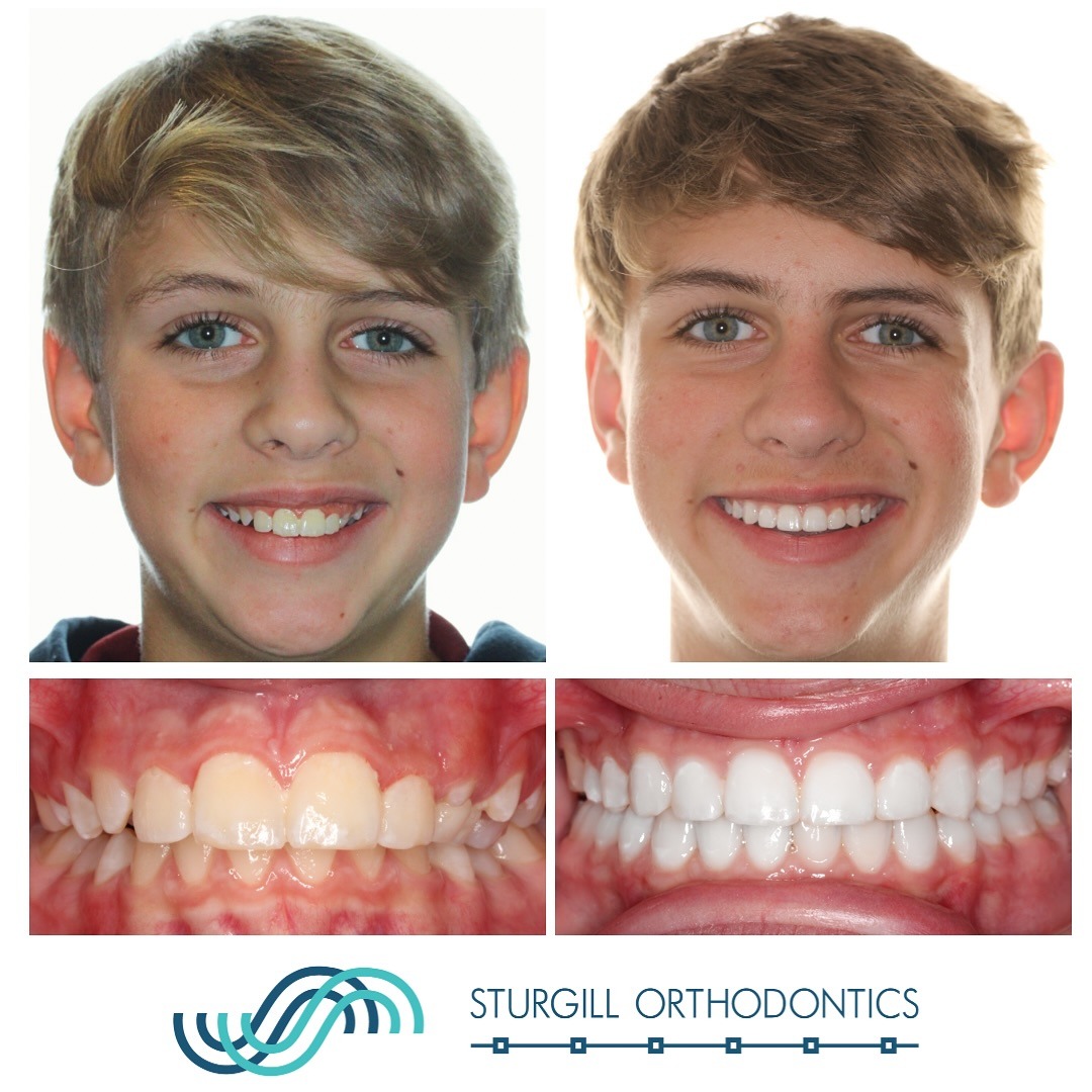 Before-and-after photos of patient Colt showing his deep bite and crowded teeth corrected with a Crossbow appliance and braces, an example of orthodontic appliances in Johnson City at Sturgill Orthodontics.