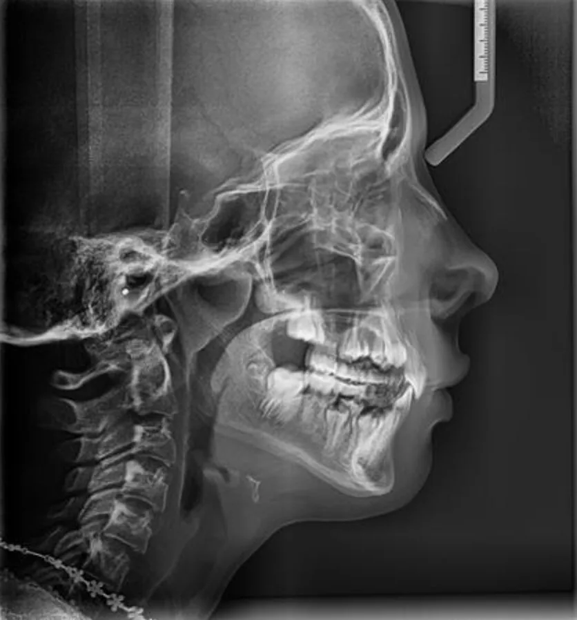 Side-view cephalometric x-ray an orthodontist uses to check jaw position and airway space during an airway evaluation for Bristol, TN families