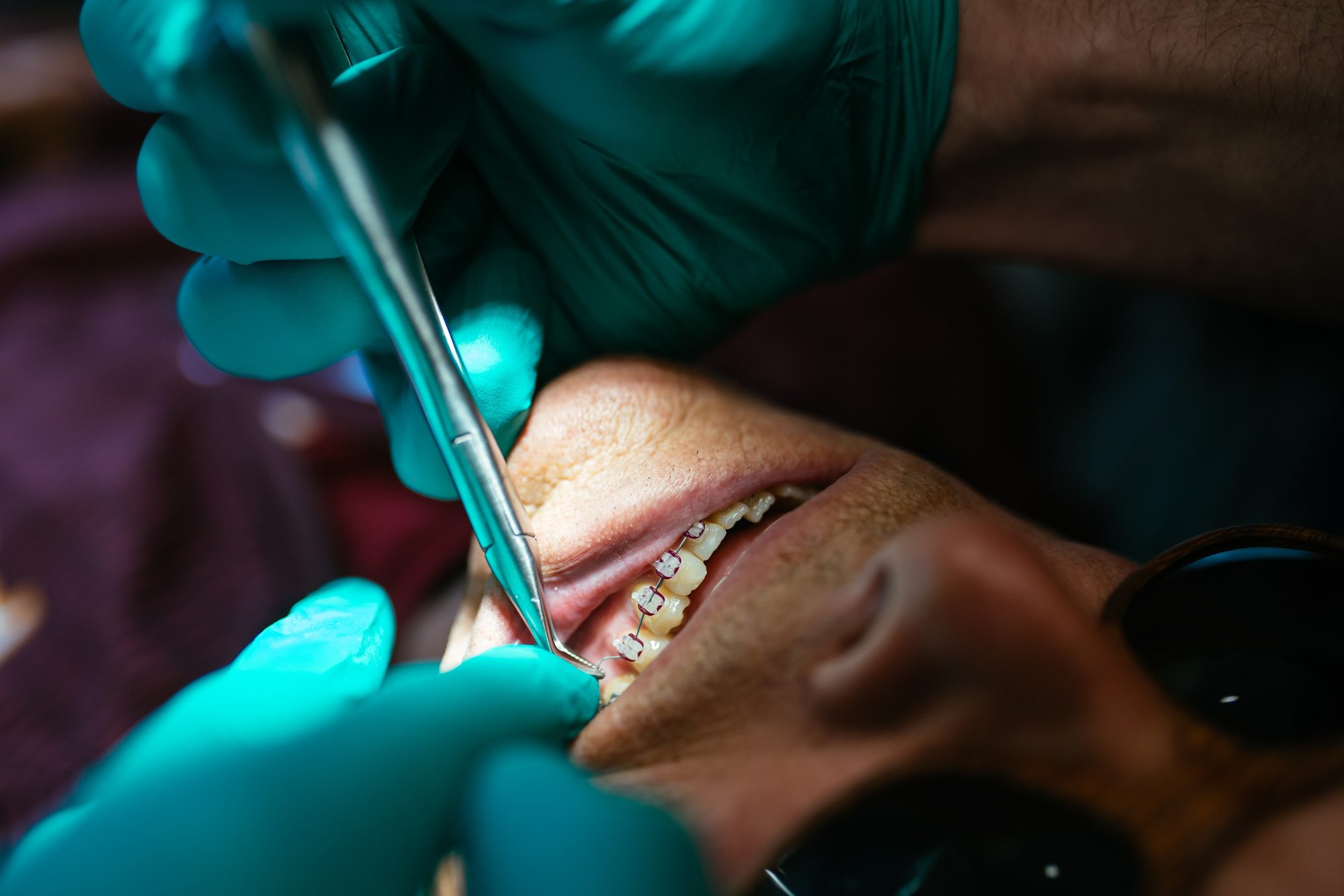 Close-up of metal braces brackets being placed on an adult patient’s teeth